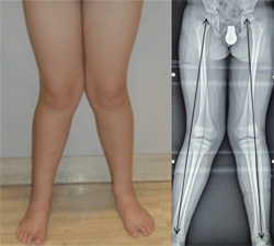 Imagen que muestra las piernas de un niño con las rodillas torcidas hacia adentro